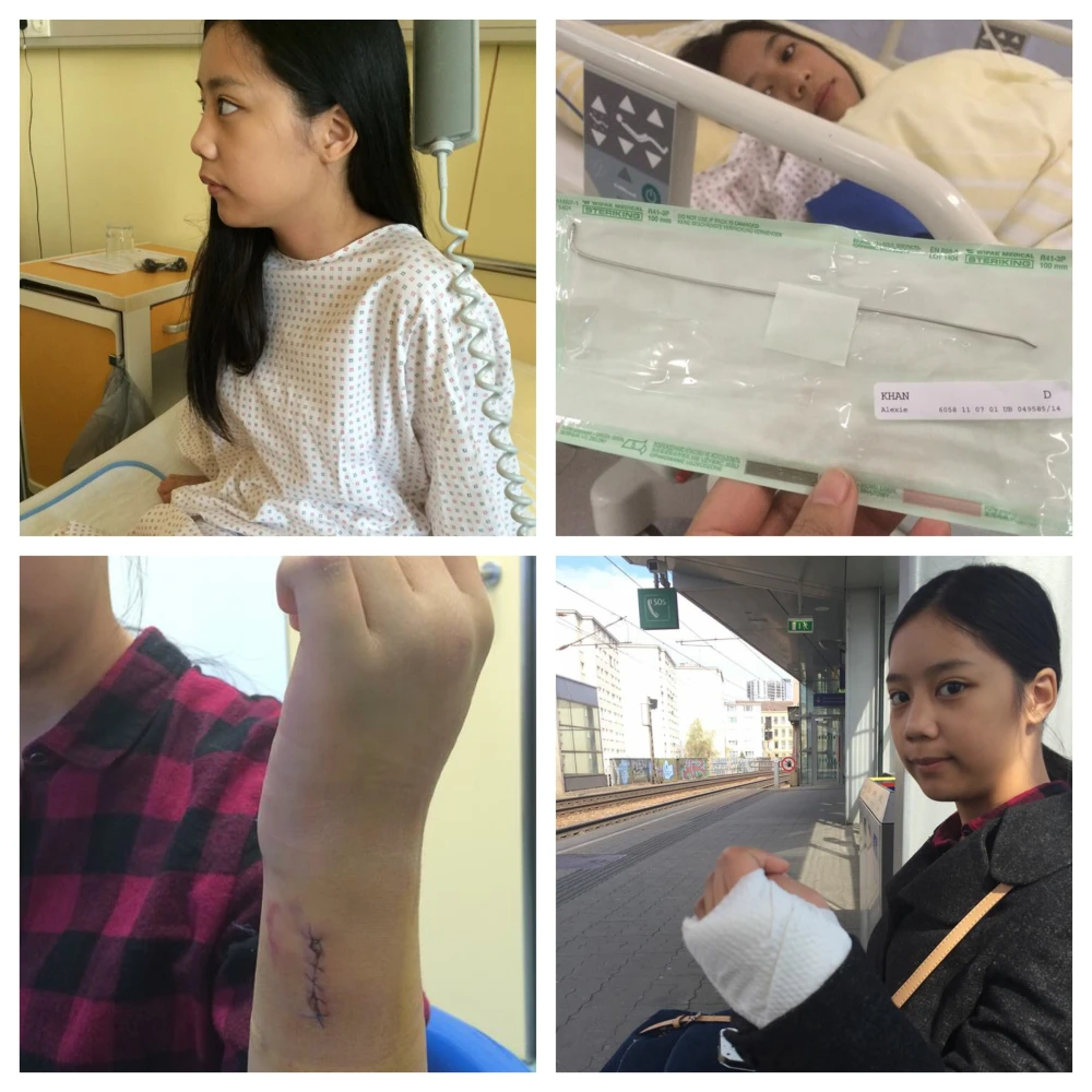 Kids Accident - Broken Arm, surgery to remove metal from arm
